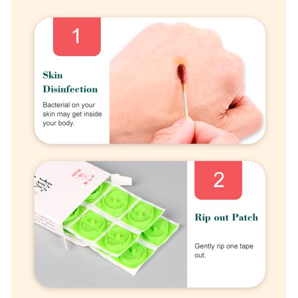 Class II Pressing Auricular Acupuncture Needles For Acupuncture Meridian Points