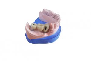 China CAD CAM Zirconia Dental Crown With Titanium Base Zirconia Abutment wholesale