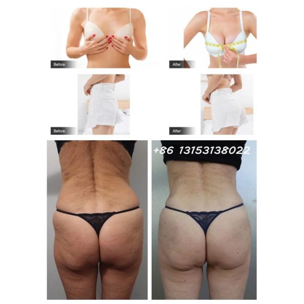 Cross Linked Hyaluronic Acid Dermal Filler For Buttock Enhancement